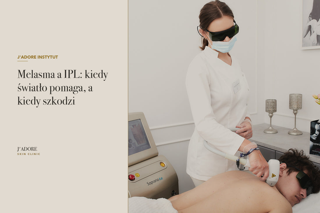 Melasma a IPL: kiedy światło pomaga, a kiedy szkodzi
