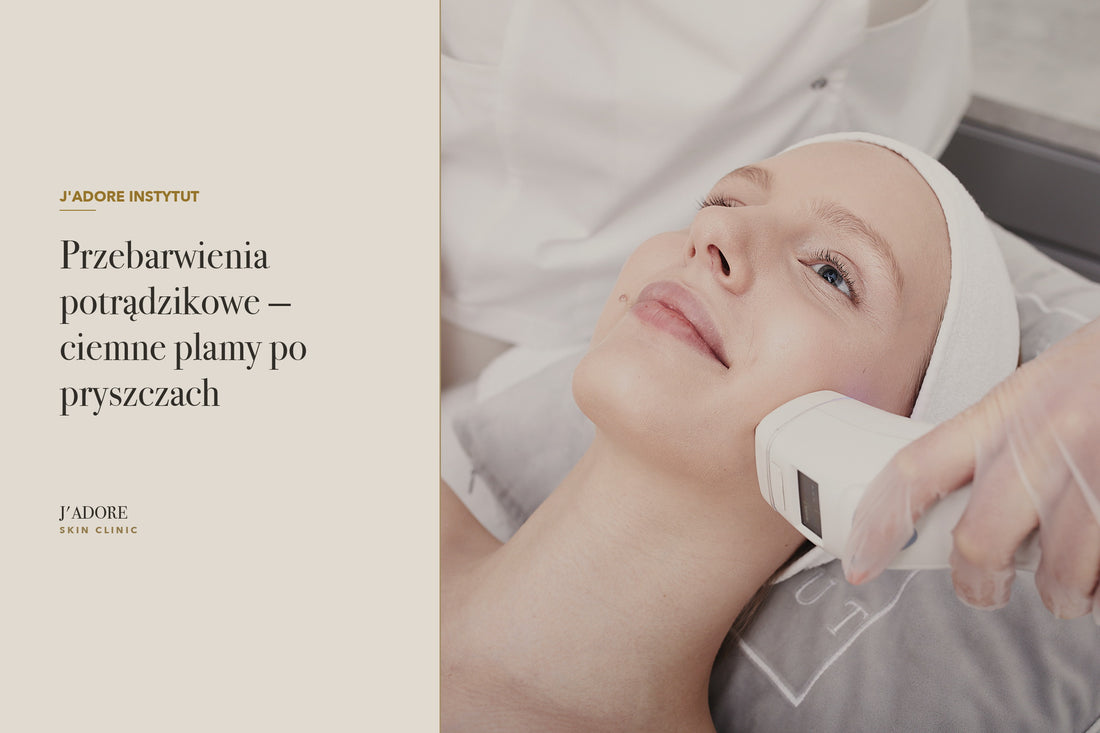 Przebarwienia potrądzikowe — ciemne plamy po pryszczach