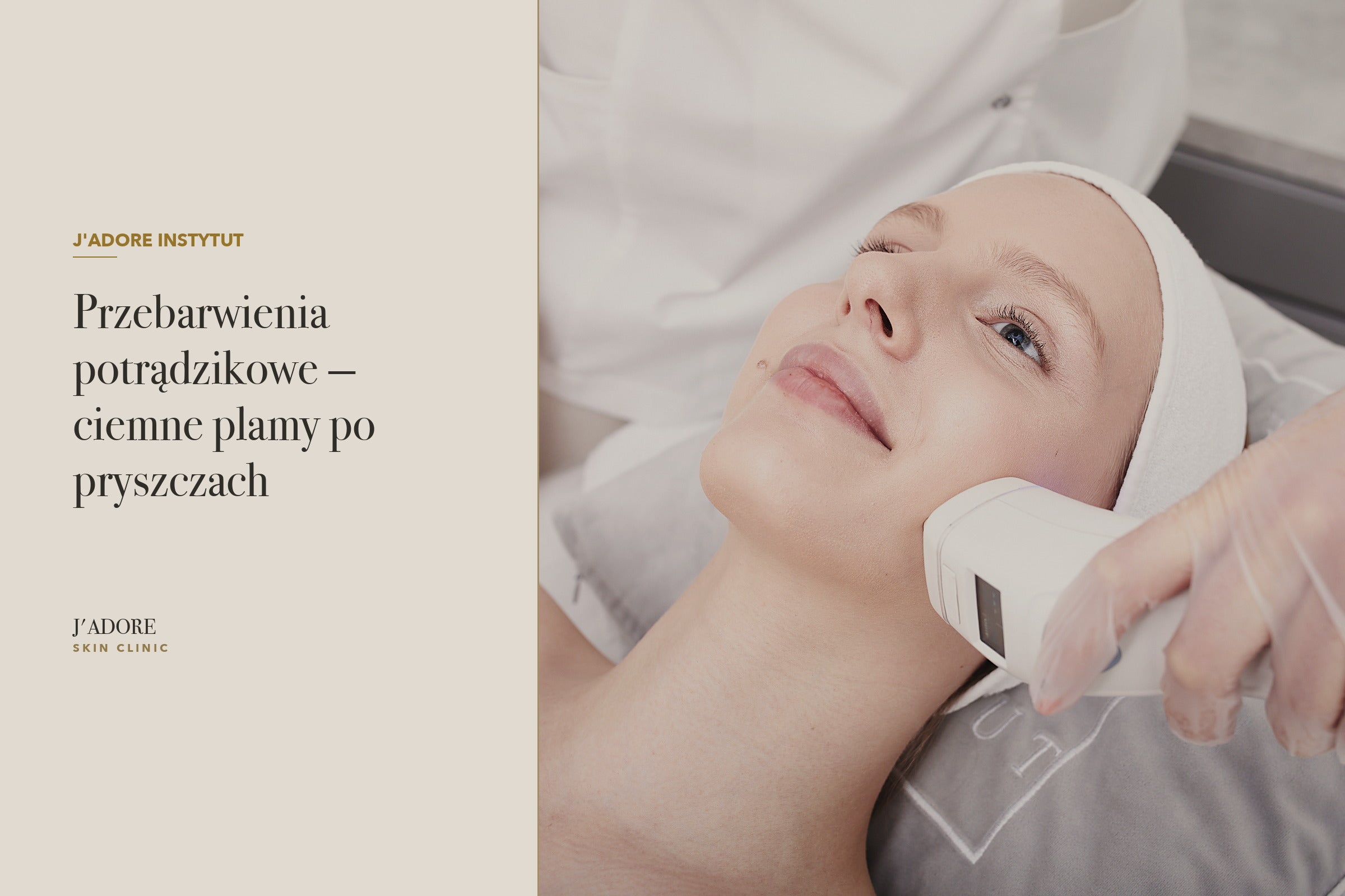 Przebarwienia potrądzikowe — ciemne plamy po pryszczach