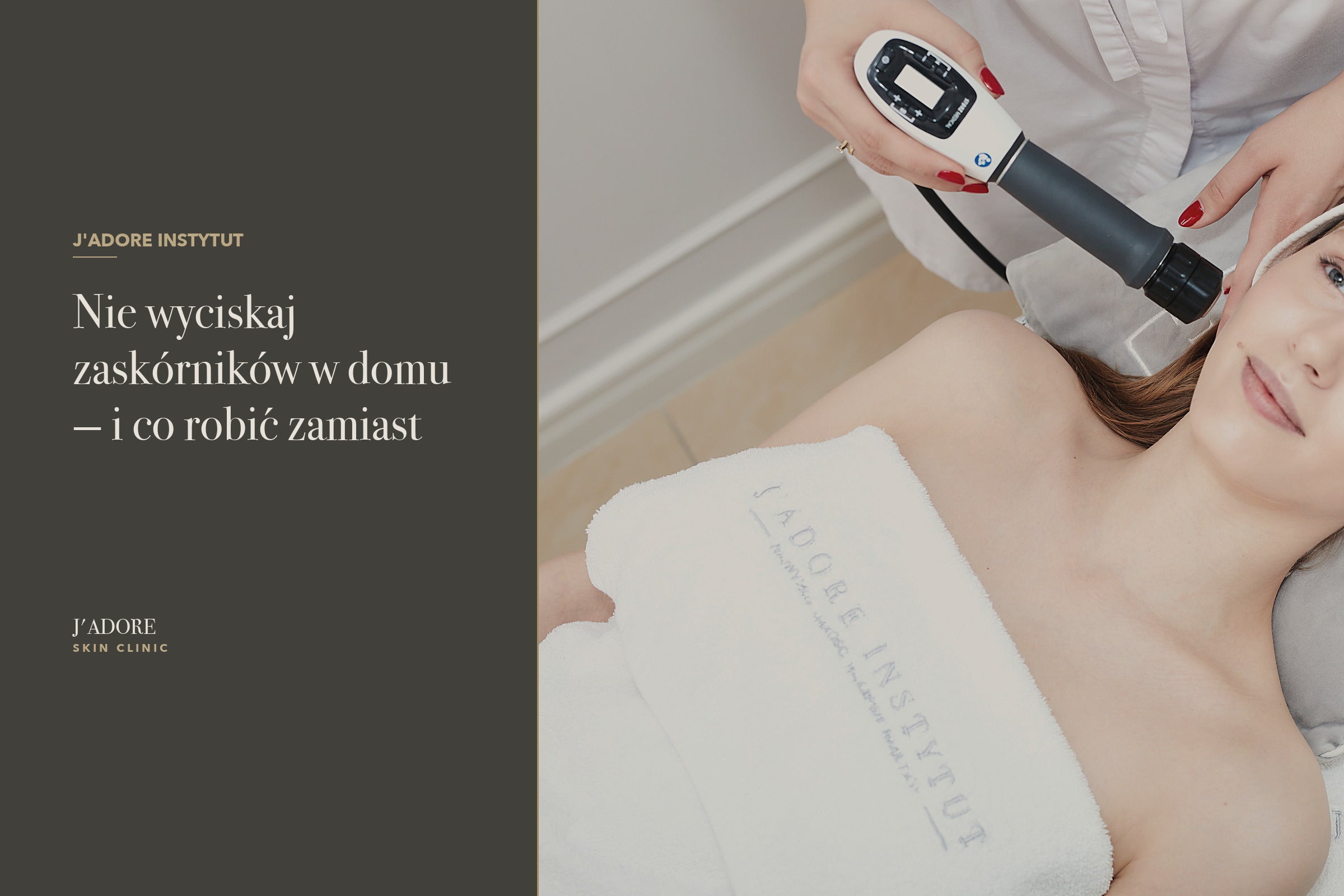 Nie wyciskaj zaskórników w domu — i co robić zamiast