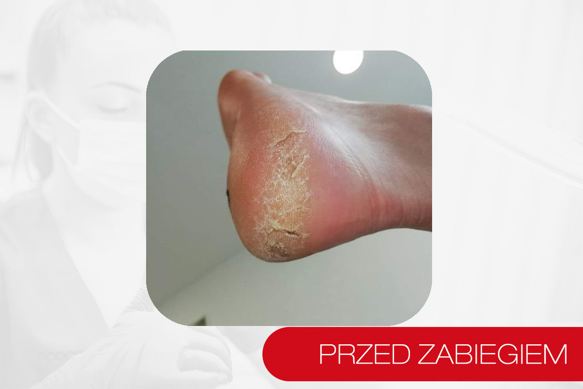 PODOFLEX® Żel zmiękczający naskórek do pedicure medycznego